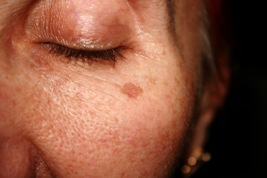 What is skin cancer?