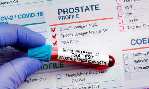 What is a PSA test?