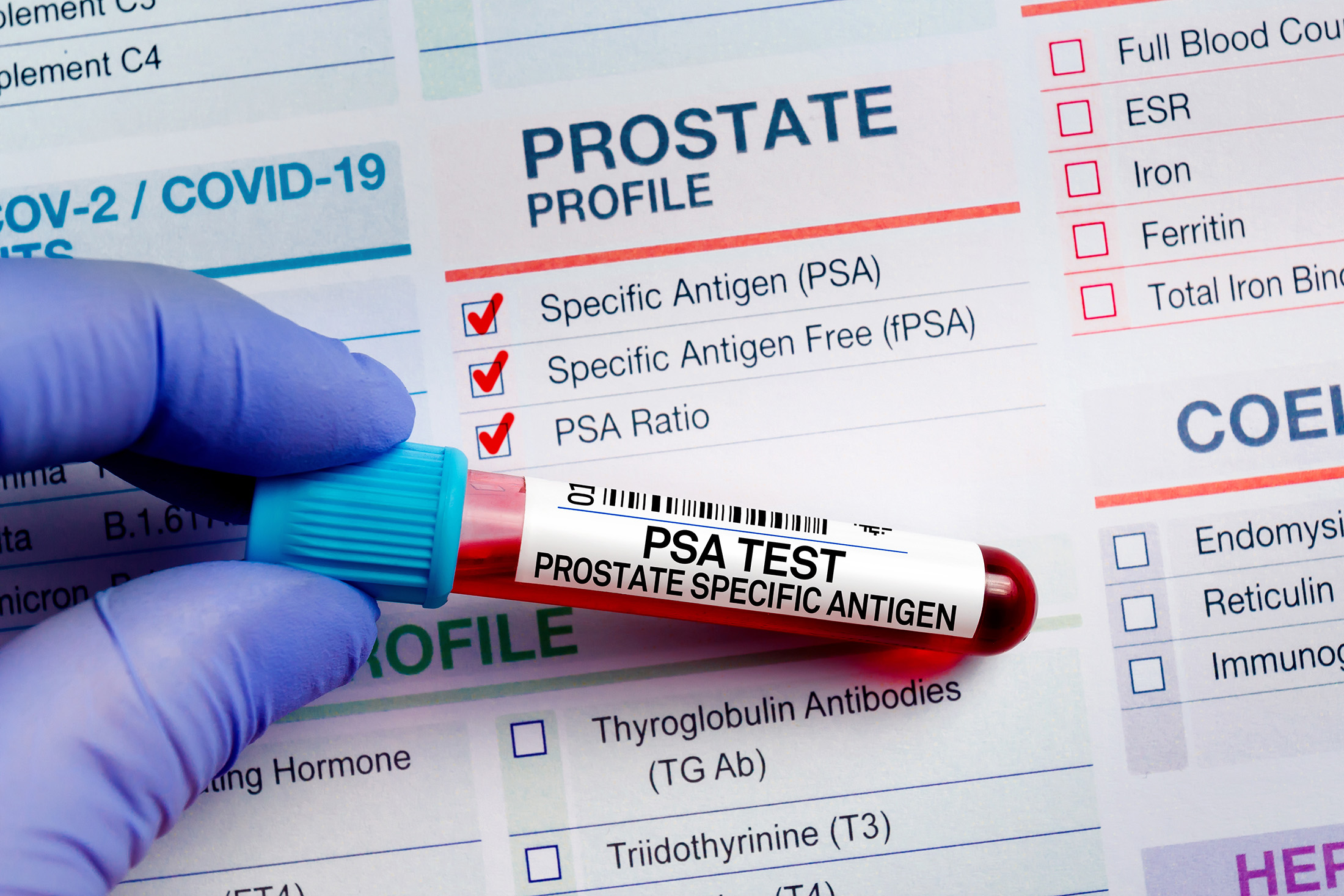 What is a PSA test?