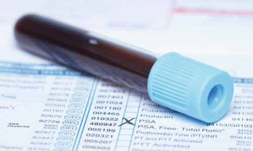PSA Test